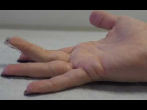 Trigger Finger Trigger Thumb OrthoInfo