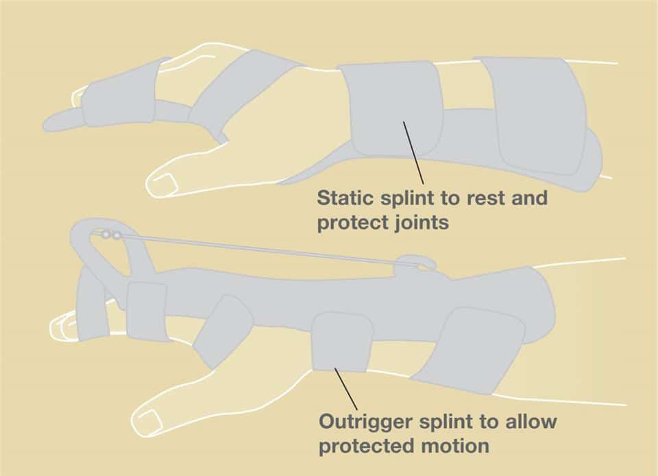 Finger Joint Replacement Richard Stephen Gilbert, M.D.