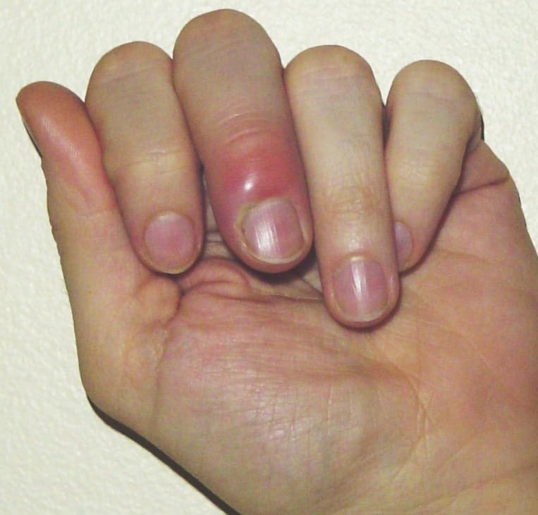 Paronychia due to finger sucking of two fingers in a 1-year-old boy:... |  Download Scientific Diagram