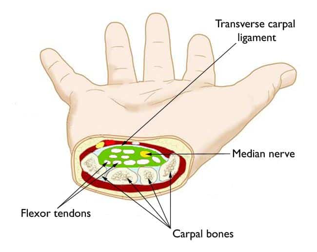 Carpal Tunnel Syndrome in Mesa, Chandler, Gilbert, Tempe, and Phoenix