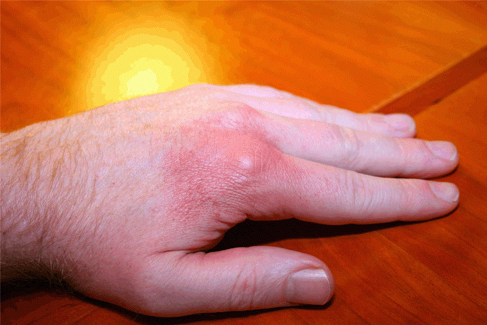 skin-colored-nodules-on-the-knuckles-quiz-case-allergy-and-clinical