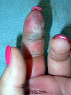 finger infection