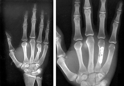 Why can't I move my ring fingers and pinkies independently from each other?  - Quora